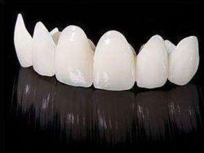 烤瓷牙能使用多长时间？