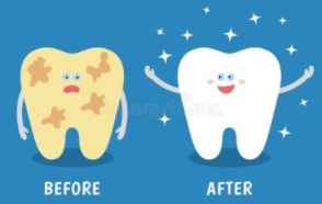 四环素牙怎么治疗呢？