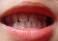 孩子的小黑牙分为几种？