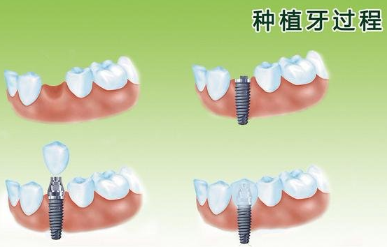 糖尿病人可以种植牙吗?