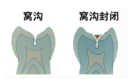 窝沟封闭需要哪些装备